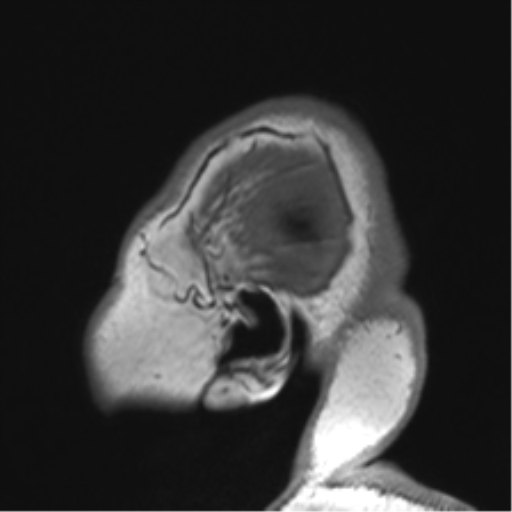 Cerebellopontine angle meningioma (Radiopaedia 48434-53348 Sagittal T1 8).png