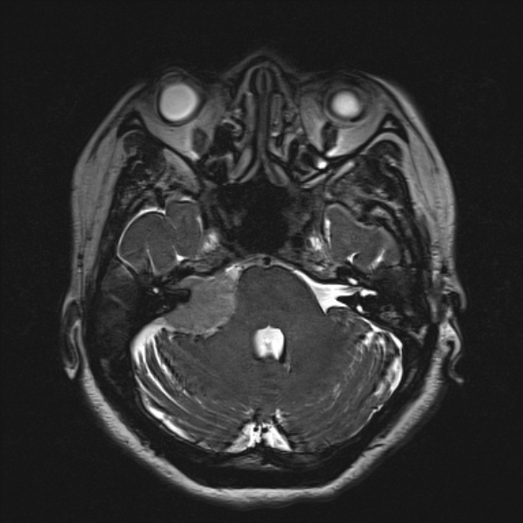 Cerebellopontine angle meningioma (Radiopaedia 53561-59591 Axial 3D volume T2 63).jpg