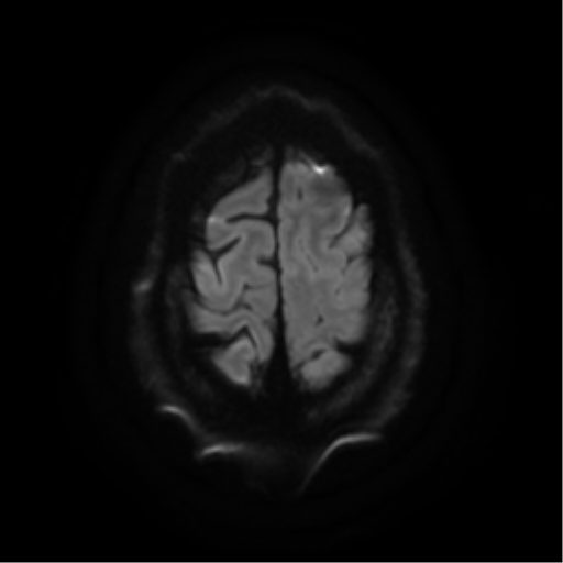 File:Cerebral abscess (Radiopaedia 57774-64740 Axial DWI 26).png