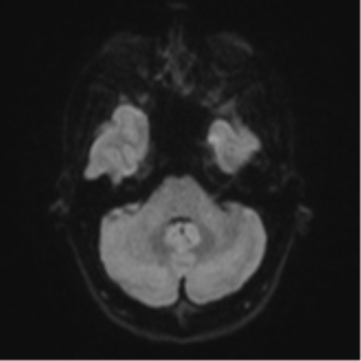 Cerebral abscess (Radiopaedia 60342-68009 Axial DWI 44).png