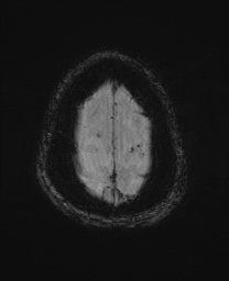 File:Cerebral amyloid angiopathy-related inflammation (Radiopaedia 74836-85849 Axial SWI 65).jpg