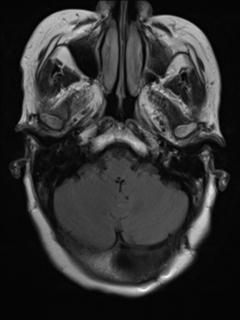 File:Cerebral amyloid angiopathy (Radiopaedia 29129-29518 Axial FLAIR 4).jpg