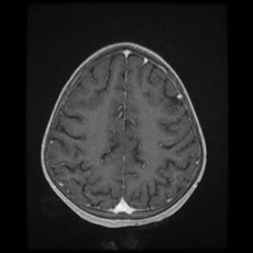Cerebral and spinal tuberculosis (Radiopaedia 90489-107837 Axial T1 C+ 146).jpg