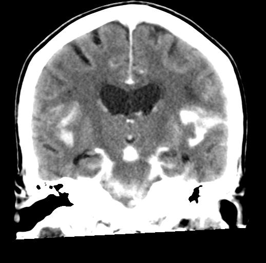 File:Cerebral aneurysm with rupture (Radiopaedia 29933-30460 Coronal non-contrast 19).jpg