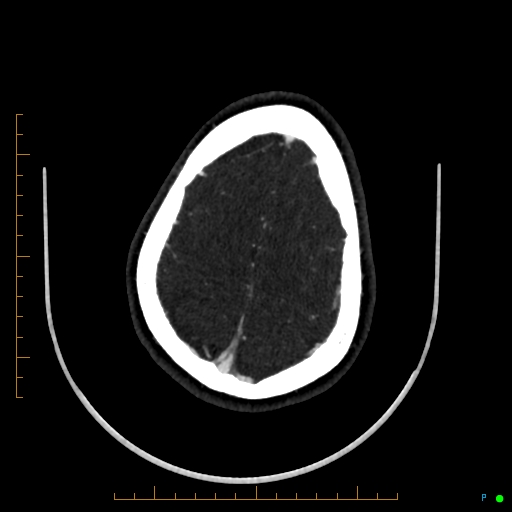 Cerebral arteriovenous malformation (AVM) (Radiopaedia 78162-90706 Axial CTA 228).jpg