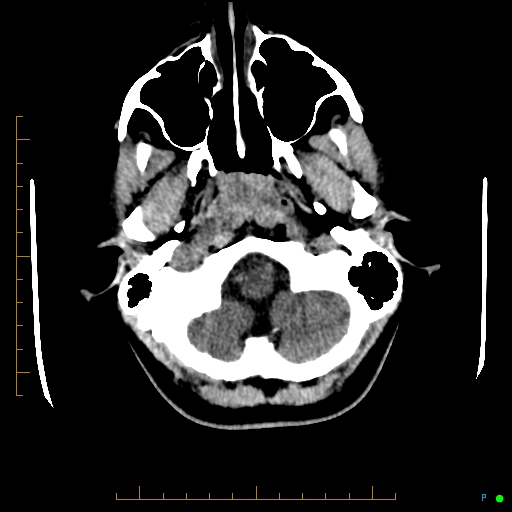 Cerebral arteriovenous malformation (AVM) (Radiopaedia 78162-90706 Axial non-contrast 10).jpg
