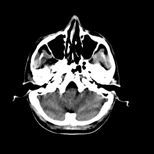 Cerebral arteriovenous malformation (Radiopaedia 28518-28759 Axial non-contrast 12).jpg
