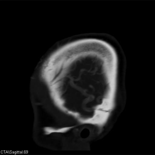 Cerebral arteriovenous malformation (Radiopaedia 28518-28759 D 66).jpg