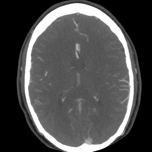 File:Cerebral arteriovenous malformation (Radiopaedia 39259-41505 AX CEREBRAL CTA 33).png
