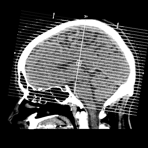 File:Cerebral arteriovenous malformation (Radiopaedia 39259-41505 Brain Ax 5mm 1).png