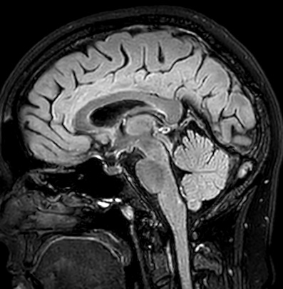 Cerebral arteriovenous malformation (Radiopaedia 74411-85746 Sagittal FLAIR 56).jpg