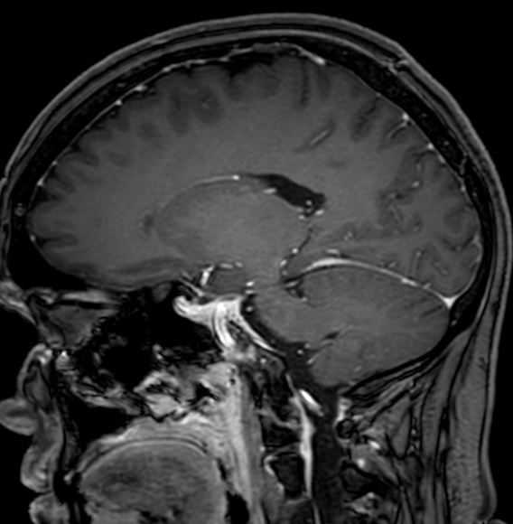 Cerebral arteriovenous malformation (Radiopaedia 74411-85746 Sagittal T1 C+ 51).jpg