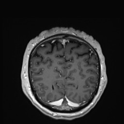 Cerebral arteriovenous malformation (Radiopaedia 84015-99245 Coronal T1 C+ 139).jpg