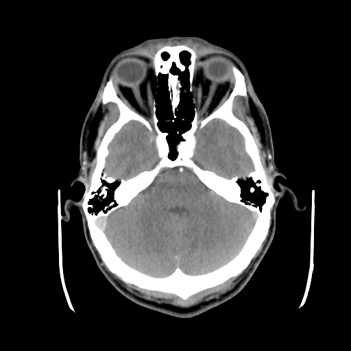Cerebral arteriovenous malformation (Spetzler-Martin grade 2) (Radiopaedia 41262-44076 Axial C+ 14).png
