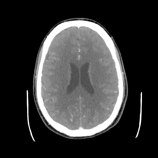Cerebral arteriovenous malformation (Spetzler-Martin grade 2) (Radiopaedia 41262-44076 Axial C+ 32).png