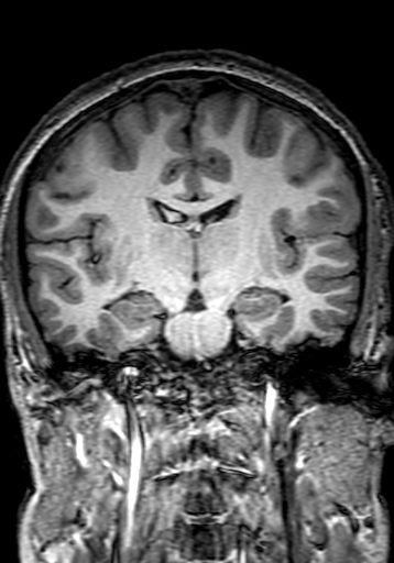 Cerebral arteriovenous malformation at posterior body of corpus callosum (Radiopaedia 74111-84925 Coronal T1 168).jpg