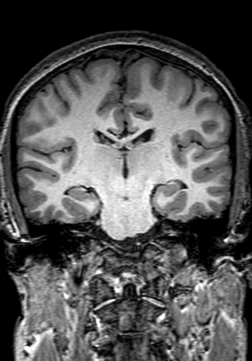 Cerebral arteriovenous malformation at posterior body of corpus callosum (Radiopaedia 74111-84925 Coronal T1 185).jpg