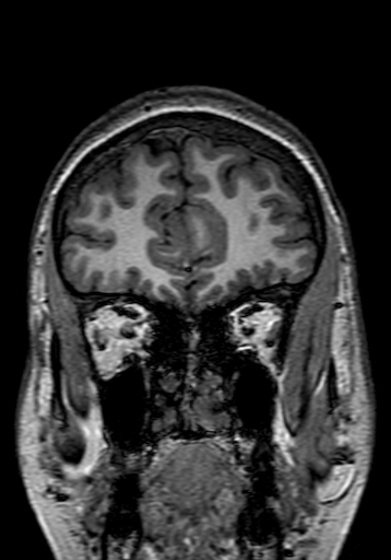 Cerebral arteriovenous malformation at posterior body of corpus callosum (Radiopaedia 74111-84925 Coronal T1 45).jpg
