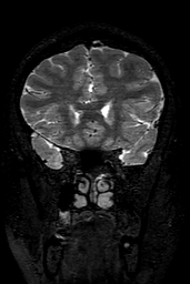 Cerebral arteriovenous malformation at posterior body of corpus callosum (Radiopaedia 74111-84925 Coronal T2 51).jpg