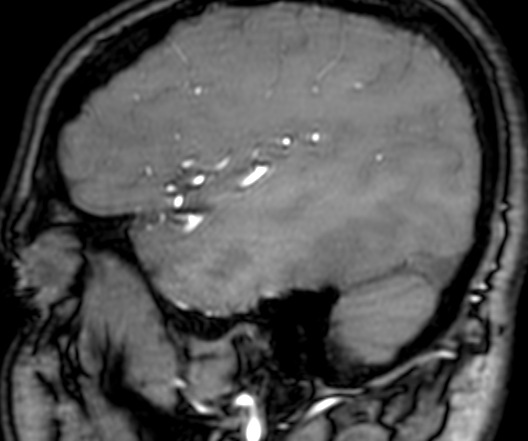 Cerebral arteriovenous malformation at posterior body of corpus callosum (Radiopaedia 74111-84925 J 330).jpg
