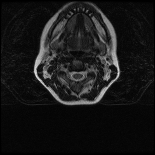 File:Cerebral autosomal dominant arteriopathy with subcortical infarcts and leukoencephalopathy (CADASIL) (Radiopaedia 41018-43763 Ax T2 C2-T1 6).png