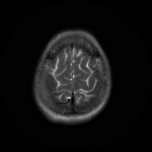File:Cerebral autosomal dominant arteriopathy with subcortical infarcts and leukoencephalopathy (CADASIL) (Radiopaedia 41018-43763 Ax T2 PROP 18).png