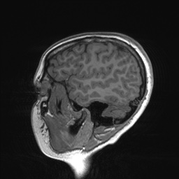 File:Cerebral cavernous venous malformation (Radiopaedia 70008-80021 Sagittal T1 61).jpg