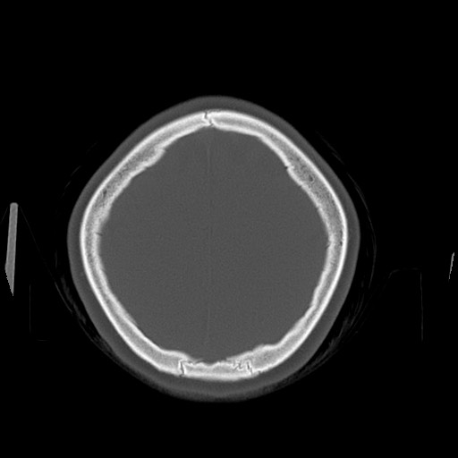Cerebral cavernous venous malformation (Radiopaedia 70008-80022 Axial bone window 45).jpg