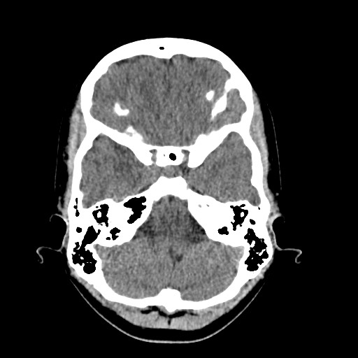 Cerebral cavernous venous malformation (Radiopaedia 70008-80022 Axial non-contrast 10).jpg