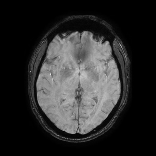 Cerebral cavernous venous malformation (Zabramski type II) (Radiopaedia 85511-101198 Axial SWI 64).jpg