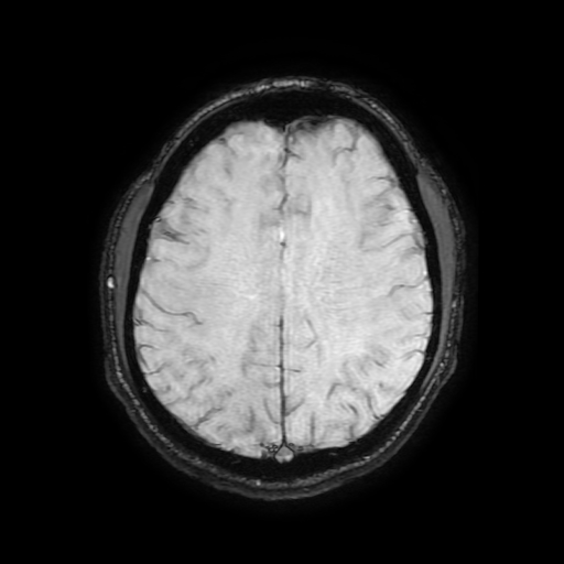 Cerebral cavernous venous malformation (Zabramski type II) (Radiopaedia 85511-101198 Axial SWI 84).jpg