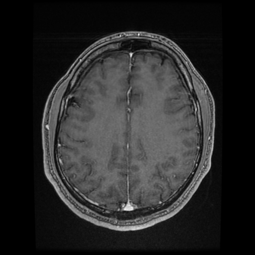 Cerebral cavernous venous malformation (Zabramski type II) (Radiopaedia 85511-101198 Axial T1 C+ fat sat 31).jpg