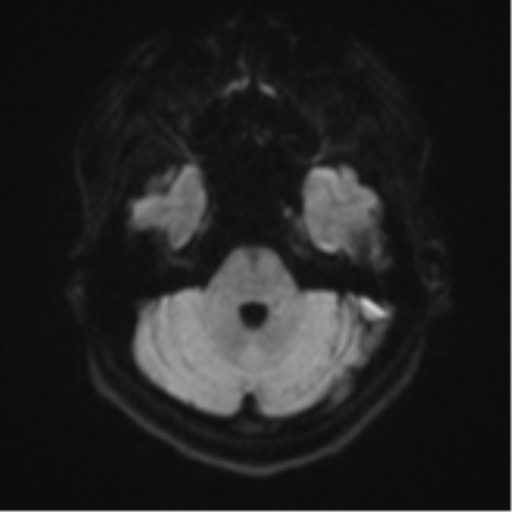 Cerebral cavernous venous malformations (Radiopaedia 48117-52946 Axial DWI 35).png