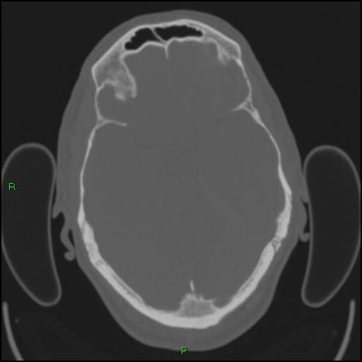 File:Cerebral contusions (Radiopaedia 33868-35039 Axial bone window 72).jpg