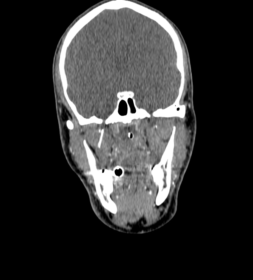 Cerebral edema in an overdose patient (Radiopaedia 72005-82539 B 18).jpg
