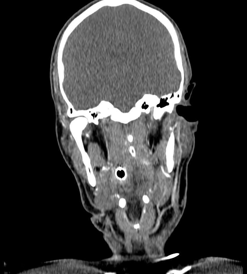 Cerebral edema in an overdose patient (Radiopaedia 72005-82539 B 51).jpg