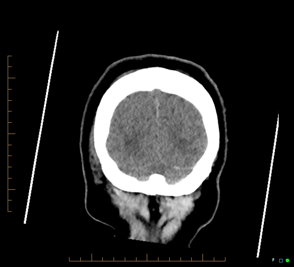 Cerebral fat embolism (Radiopaedia 85521-101220 Coronal non-contrast 56).jpg