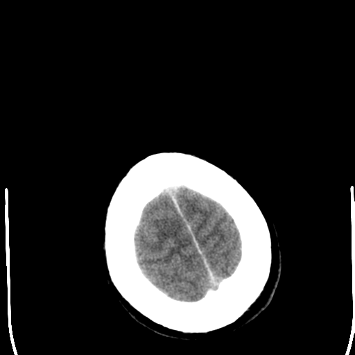 File:Cerebral hemorrhagic contusions- temporal evolution (Radiopaedia 40224-42752 Axial non-contrast 27).png
