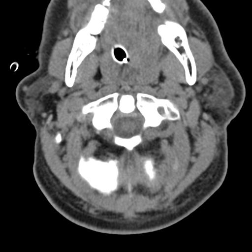 Cerebral hemorrhagic contusions and cervical spine fractures (Radiopaedia 32865-33841 F 13).jpg