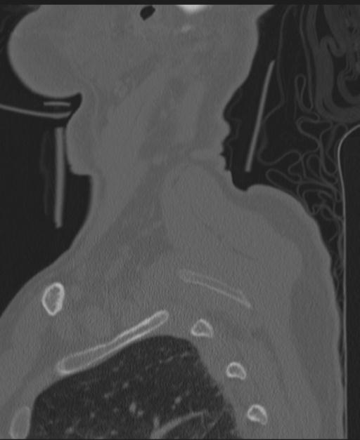 Cerebral hemorrhagic contusions and cervical spine fractures (Radiopaedia 32865-33841 Sagittal bone window 6).jpg