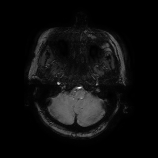Cerebral metastases - melanoma (Radiopaedia 80972-94522 Axial SWI 17).jpg