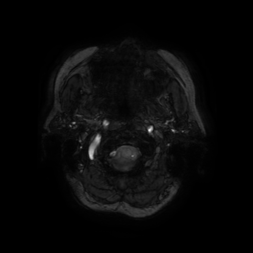 Cerebral metastases - melanoma (Radiopaedia 80972-94522 Axial SWI 4).jpg