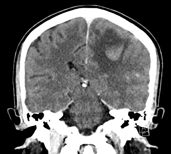 Cerebral metastases - testicular choriocarcinoma (Radiopaedia 84486-99855 D 37).jpg