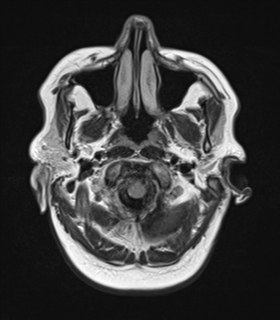 File:Cerebral metastases mimicking abscesses (Radiopaedia 45841-50131 Axial FLAIR 3).png