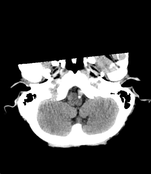 File:Cerebral metastasis (Radiopaedia 46744-51247 Axial non-contrast 5).png