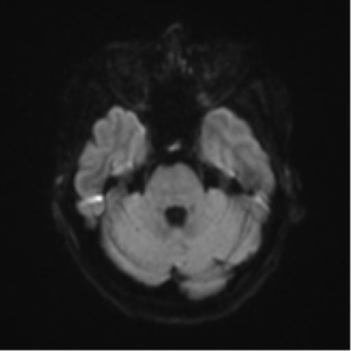 Cerebral metastasis (Radiopaedia 46744-51248 Axial DWI 36).png