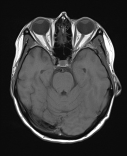 File:Cerebral metastasis (Radiopaedia 46744-51248 Axial T1 9).png