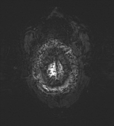 Cerebral metastasis - melanoma (Radiopaedia 54718-60954 Axial SWI 56).png