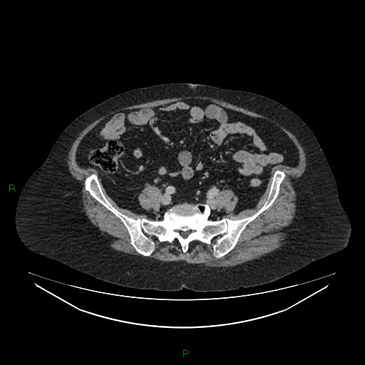 File:Cerebral metastasis from renal cell carcinoma (Radiopaedia 82306-96378 A 131).jpg