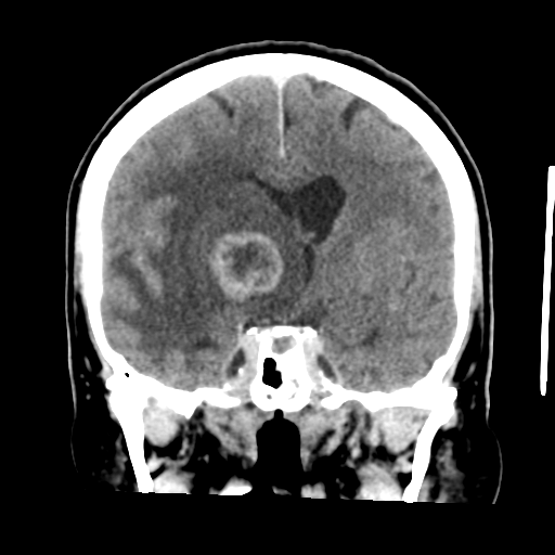 Cerebral metastasis to basal ganglia (Radiopaedia 81568-95412 Coronal C+ delayed 30).png
